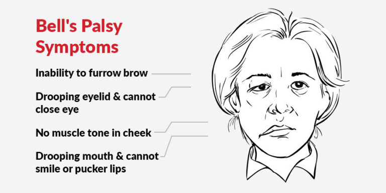 What Is Facial Palsy