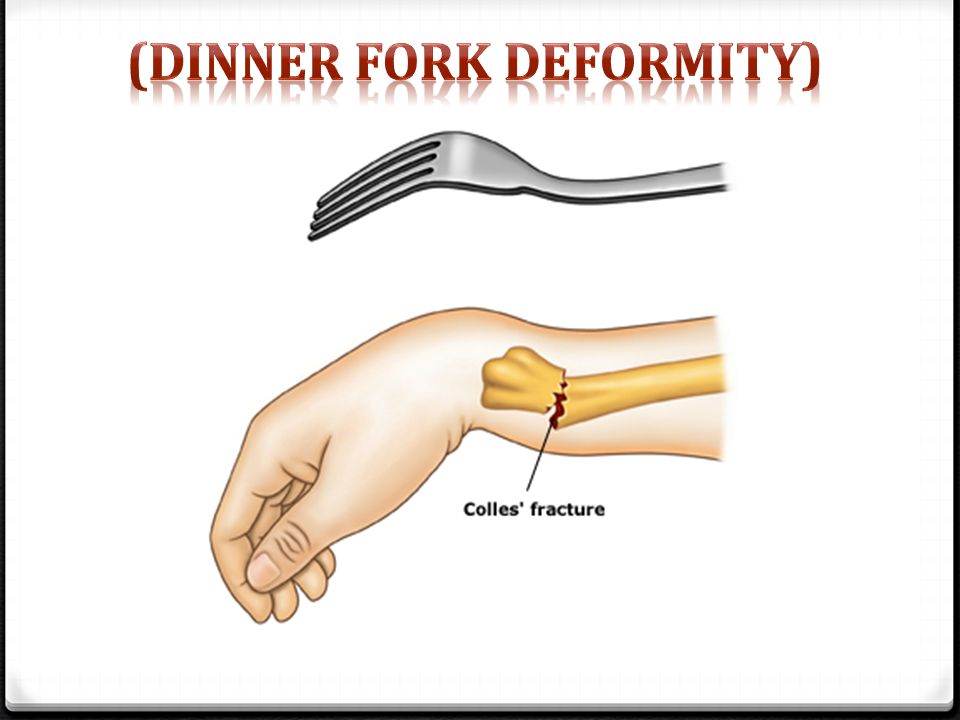 Dinner Fork Deformity in Colle's Fracture