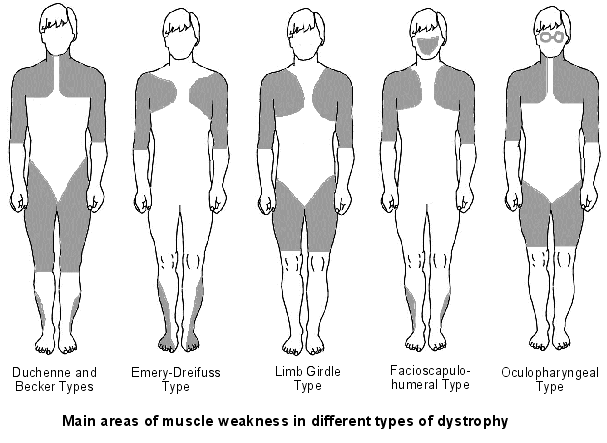 Types Of Muscular Dystrophies