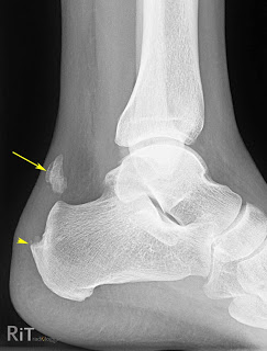 X Ray in Achillis Tendinitis Showing Calcification