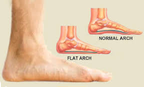 Flatfoot (pes planus)