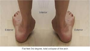 Flatfoot (pes planus)