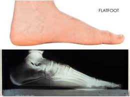 x-ray of flatfoot