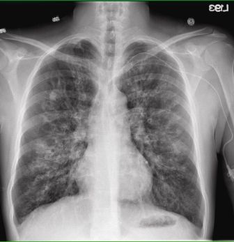 CHEST X-RAY IN CF