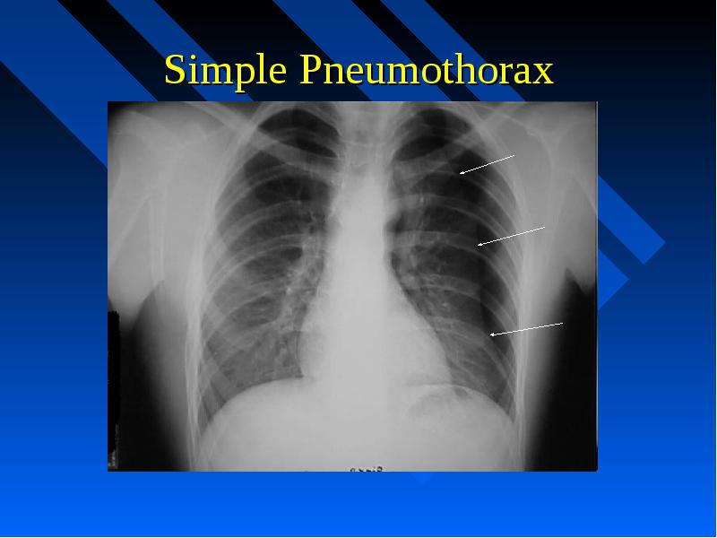 CHEST RADIOGRAPH