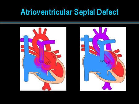 Atrioventricular-Septal-Defect-Picture