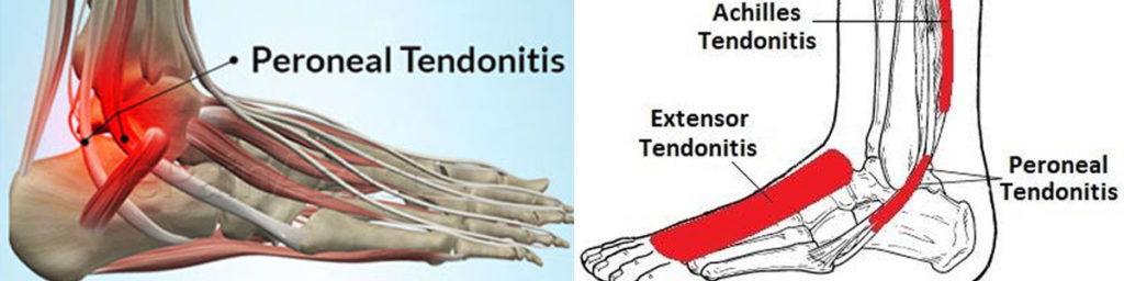 Peroneal Tendonitis
