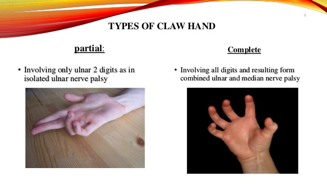 Claw Hand Deformity- Ulnar Nerve Injury