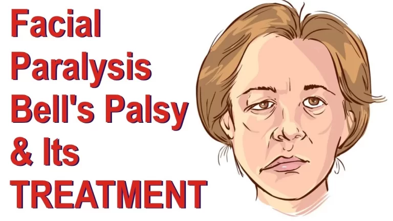 Bell’s Palsy & Physiotherapy Treatment