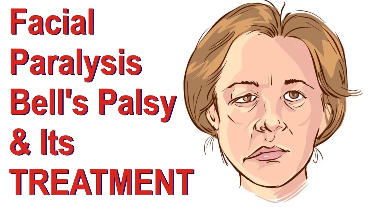 Bell’s Palsy Treatment