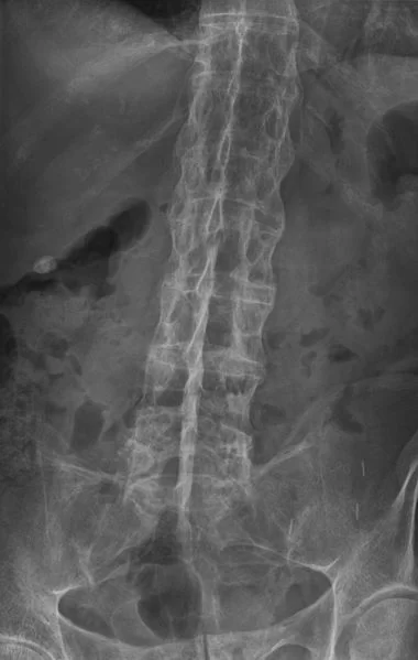 Bamboo spine of AS X Ray