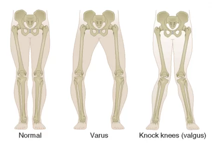 Knee joint Deformities in Rheumatoid Arthritis