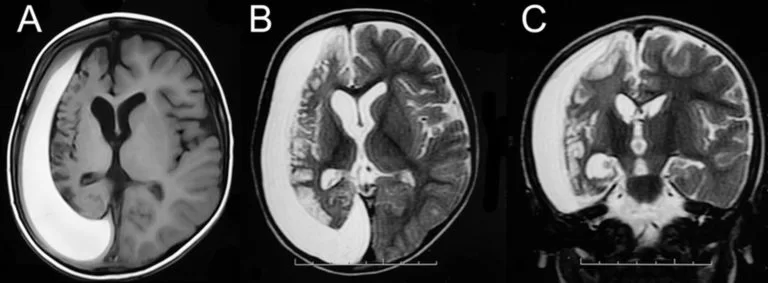 MRI Brain Hemiplegia