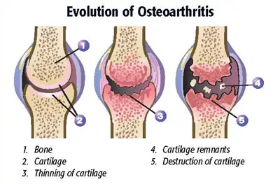 Pathophysiology of osteoarthritis