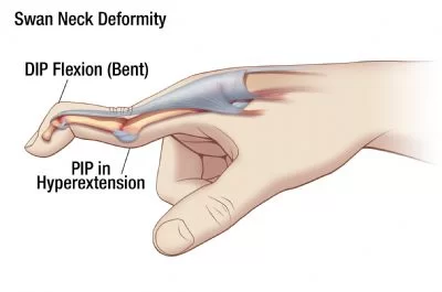Swan Neck Deformity: Physiotherapy Treatment