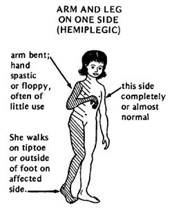 Symptom Of Hemiplegia