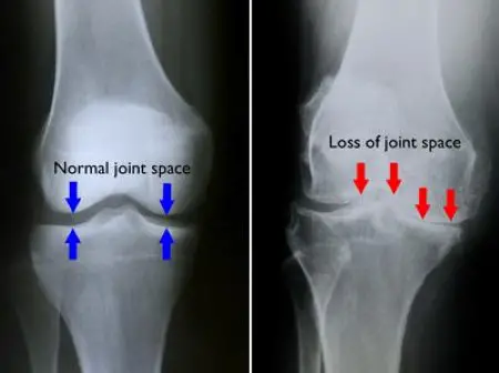 X-ray of OA knee