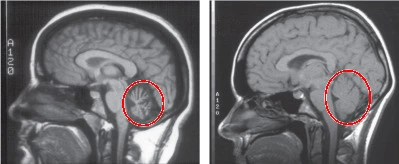 Cerebellar ataxia MRI