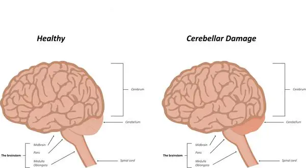 Cerebellar ataxia