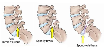 Lumbar Spondylosis And Spondylitis