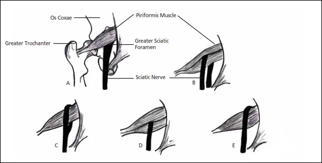 Variations in the relationship of the sciatic nerve to the piriformis muscle
