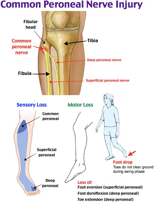 Radial Nerve Injury, Cause,Symptom, Physiotherapy Treatment