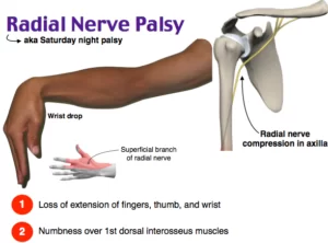 Radial Nerve Injury