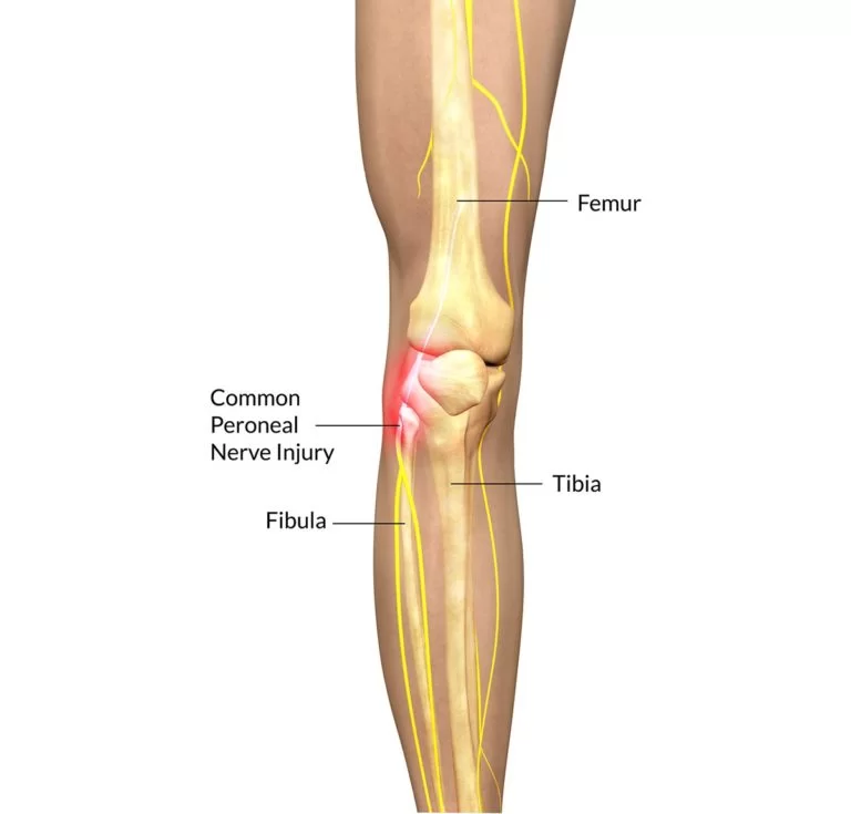 Common peroneal nerve injury