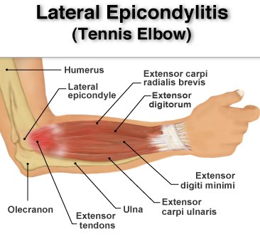 Lateral Epicondylitis