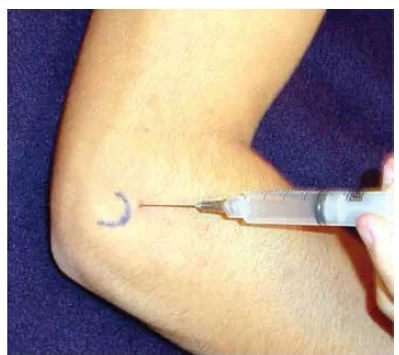 Steroid injection for lateral epicondylitis
