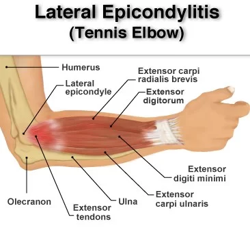 Tennis elbow (lateral epicondylitis)