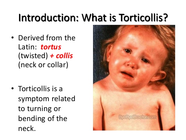 TORTICOLLIS: PHYSIOTHERAPY MANAGEMENT