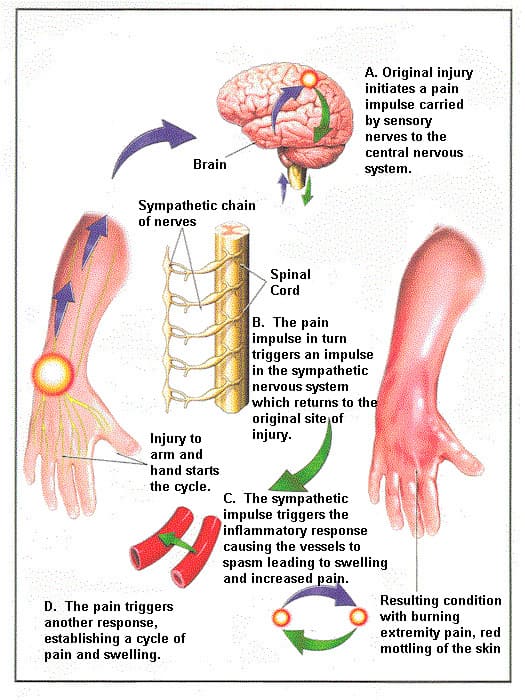 Mechanism of shoulder hand syndrome