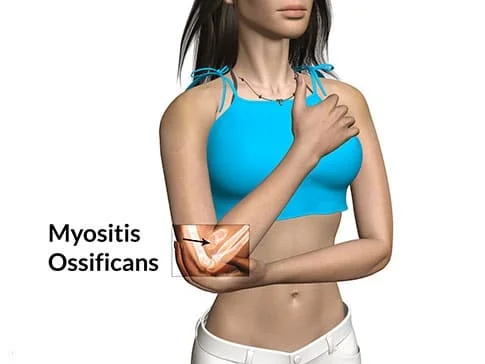 Myositis Ossificans