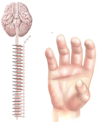 Shoulder-hand syndrome