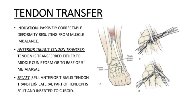 Club Foot Or Ctev Congenital Talipes Equino Varus