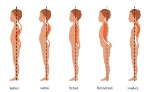 Abnormal Posture