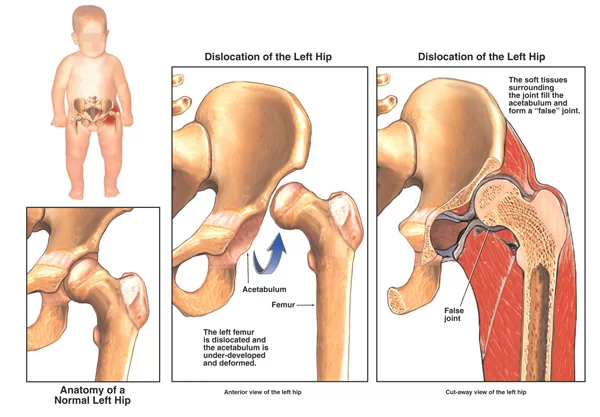 Congenital Dislocation of Hip