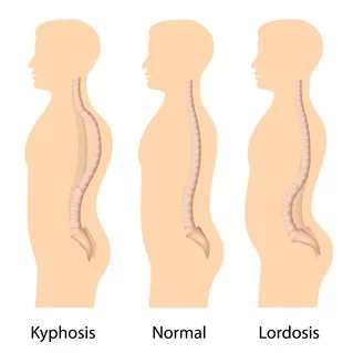 Kyphosis- Normal-Lordosis