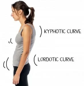 Lordosis posture with kyphosis
