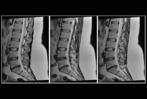 MRI of Low Back