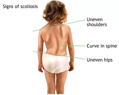 Sign Symptoms of Scoliosis