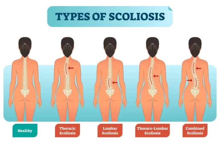 Scoliosis: Type, Cause, Symptoms, Diagnosis and Treatment, Exercise
