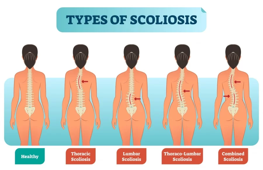 https://mobilephysiotherapyclinic.in/wp-content/uploads/2017/07/Scoliosis.webp