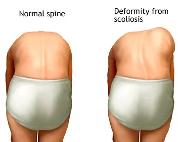 Upper Back Pain - Cause, Symptoms, Treatment