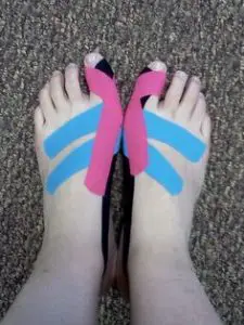 KT Taping for Hallux Valgus
