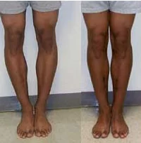 Knee Varus-Genu Varus Deformity