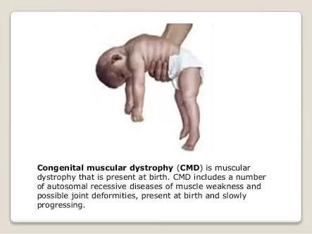 Congenital Muscular Dystrophy (CMD)