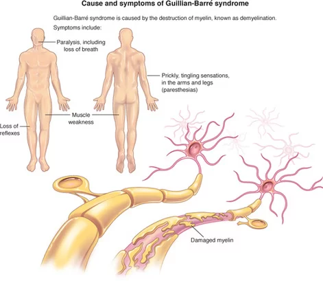 Guillain-Barre syndrome (GBS)