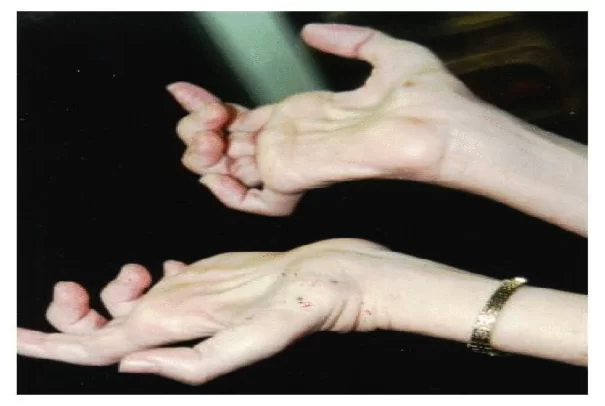Distal Muscular Dystrophy in Hands